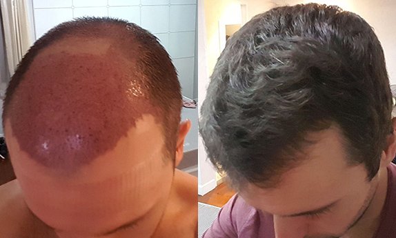 العلاج في الأردن – زراعة الشعر